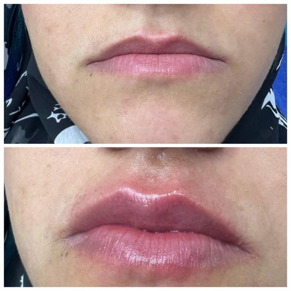 حقن الهيالورونيك في للشفاه